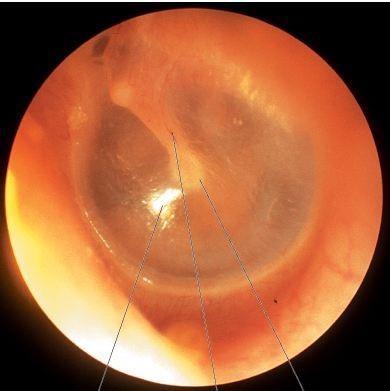 Lateral surface of tympanic membrane Handle of malleus Cone of light Note it is translucent, concave laterally The