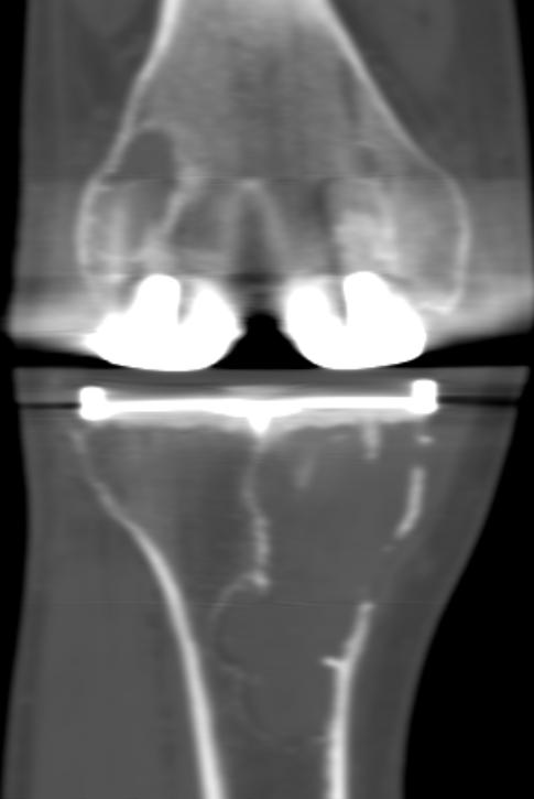 Evaluation of peri-prosthetic osteolysis Plain radiographs typically underappreciate the full