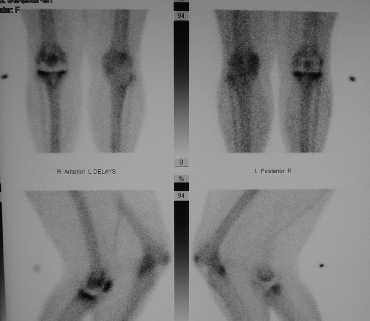 ADDITIONAL STUDIES: NUCLEAR BONE SCAN Not routinely used, but may be useful in certain situations: Loosening that may not be obvious on plan