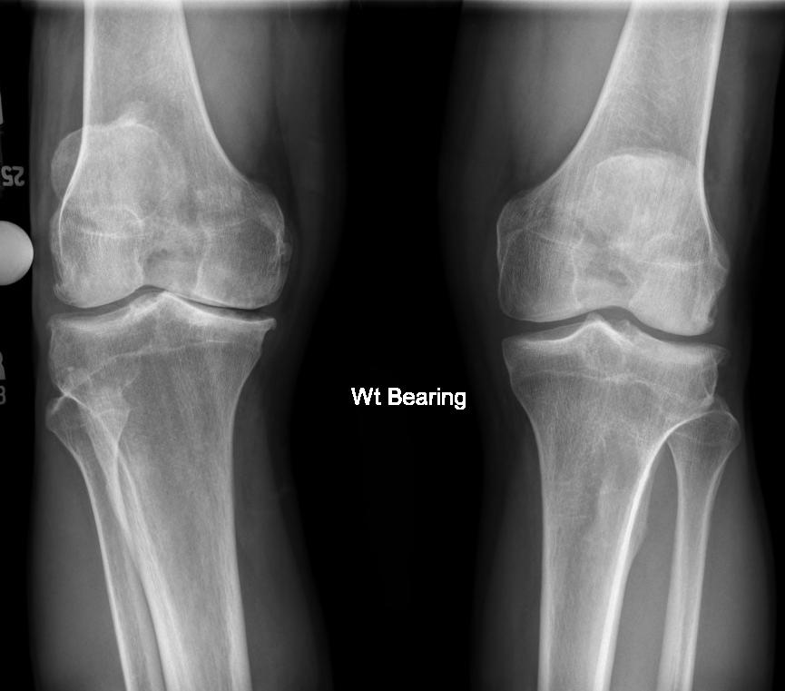 RADIOGRAPHIC EVALUATION OF THE NATIVE KNEE Standing Bilateral Weight Bearing AP: Used to assess degree and location of disease and in particular joint space narrowing.