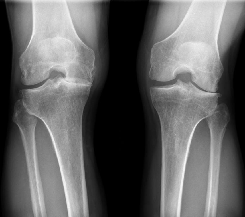 RADIOGRAPHIC EVALUATION OF THE NATIVE KNEE COPYRIGHT 2016 THE KNEE SOCIETY Bilateral PA Flexion Weight Bearing: Recommended to assess the posterior femoral condylar cartilage and is found to be more