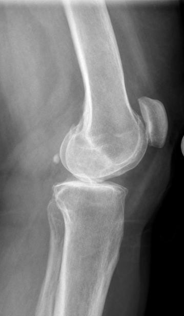 RADIOGRAPHIC EVALUATION OF THE NATIVE KNEE Lateral: Used to assess peri-articular osteophytes, patellar anatomy, patella tendon length
