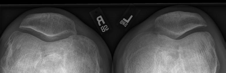 RADIOGRAPHIC EVALUATION OF THE NATIVE KNEE Bilateral Patellofemoral (Merchant) View: The preferred view is the Merchant view used to evaluate patellofemoral position, alignment and patellar