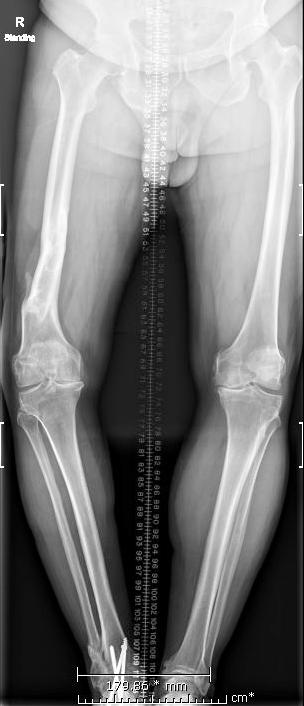 HIP TO ANKLE PLAIN RADIOGRAPHS May be used to assess extraarticular deformity and overall limb alignment May be