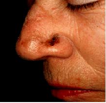 Lentigo Maligna Melanoma 5-10% of melanomas Often on face and neck More common in the