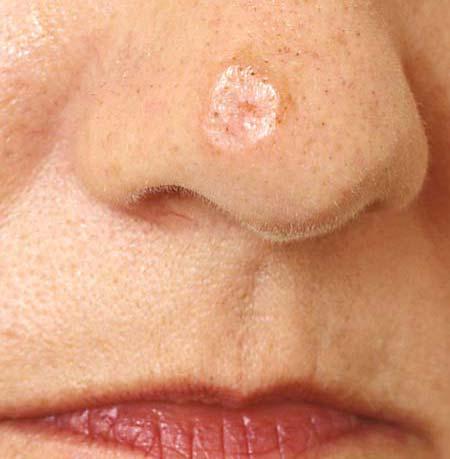 Desmoplastic melanomas rare Often in elderly (6 th or 7 th