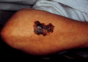 Melanoma subtypes Superficial spreading: : most common form, often arise