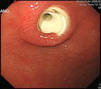 Perforation / peritonitis Leakage from around tube Bleeding