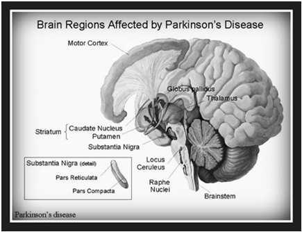 Parkinson s Disease Different from