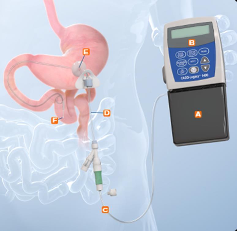 LEVODOPA INTESTINAL GEL Continuous levodopa infusion during waking hours with basal and bolus