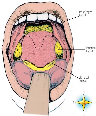 Tonsils 7 HPV-Positive Squamous Cell Carcinoma of the Palatine Tonsil Soft palate