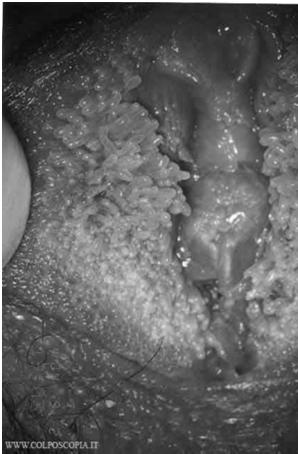 General Treatment of Genital Warts Management Primary goal is removal of symptomatic warts.