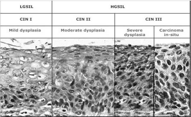 Cervical Intraepithelial