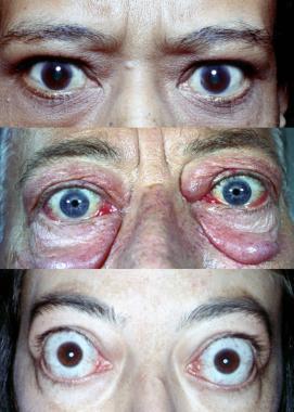 Slika 5. Gravesova bolest različiti stupnjevi manifestacije oftalmopatije [20] (Preuzeto: http://emedicine.medscape.
