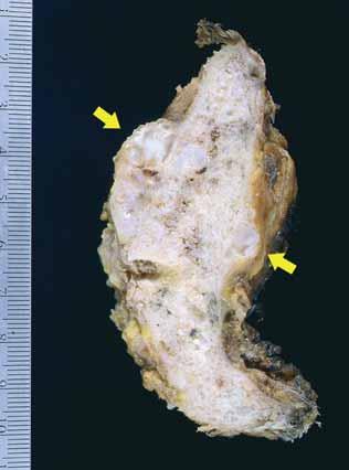 NON-MONOMELIC SYNCHRONOUS PRIMARY MULTICENTRIC CHONDROSARCOMA 245 Fig. 5. Gross specimen of the chondrosarcoma involving the right scapula.