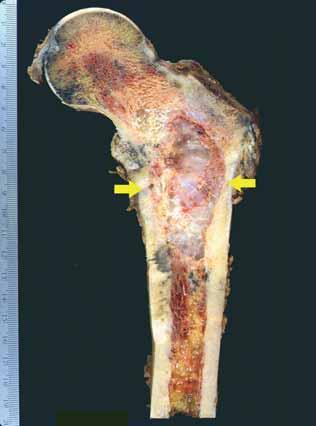 Sagittal section of the upper end of the femur demonstrating a poorly circumscribed tumour replacing the marrow space and eroding the cortex (arrows).