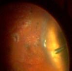 The current study evaluated the distance of the retina area that corresponded to A) the internal tip of the sclerotomy cannula and B) edge of the viewing field from the ora serrata.