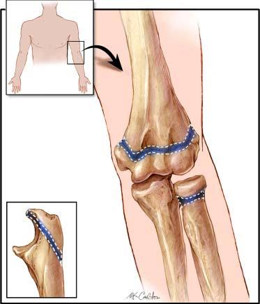 Overuse Injuries Common problems for young baseball players Skeletally immature (growing) athletes are susceptible to unique elbow injuries that occur as a result of repetitive throwing.