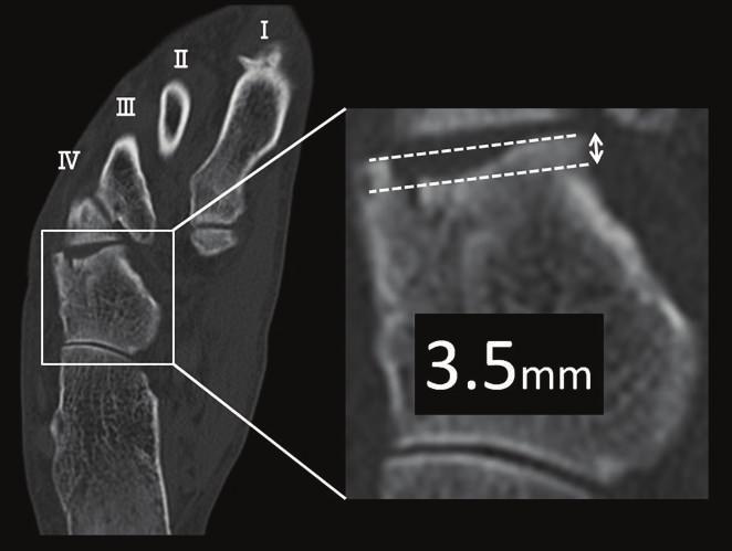 9 mm arthroscope, we examined the Lisfranc joint (Figure 3) and noted that the cuboid articular surface between the cuboid and the fourth metatarsal was crushed (Figure 4).