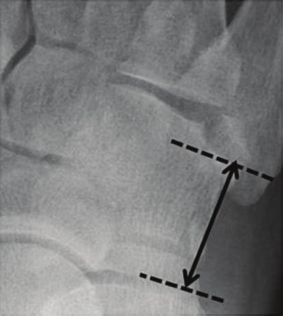 Case Reports in Orthopedics 5 24.5 mm 29.