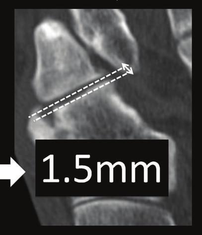 Gershon-Cohen, The nutcracker fracture of the cuboid by indirect violence, Radiology, vol. 60, no. 6, pp. 850 854, 1953. [5] O.