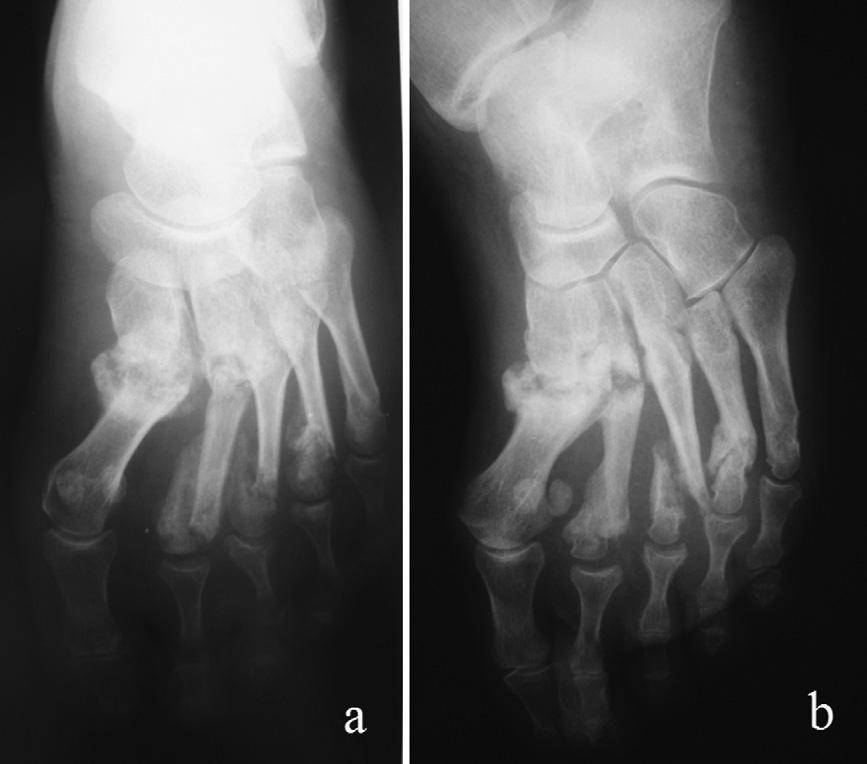292 M. Güven et al. Figure 1 (a) Fracture of the fifth metatarsal of the left foot and (b) avulsion fracture of the calcaneus of the right foot. the left foot (Fig. 3).