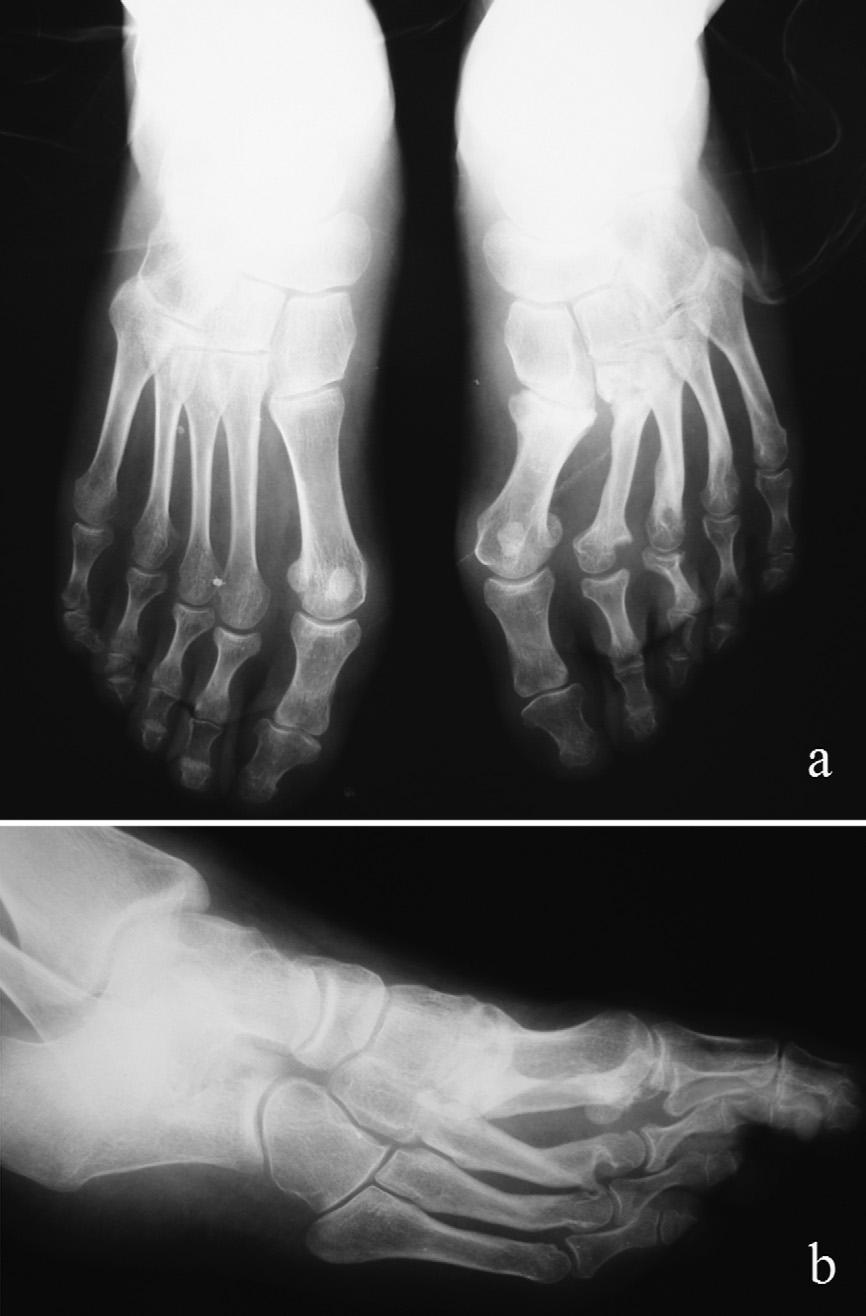 Unusual fracture with Charcot arthropathy and juvenile-onset diabetes 293 Figure 3 Radiographs at the end of the 18-month follow-up: (a) anteroposterior radiograph of both feet and (b) oblique