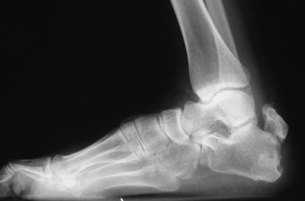 294 M. Güven et al. Figure 4 Lateral radiograph of the right foot and ankle at the end of the 18-month follow-up. tures.