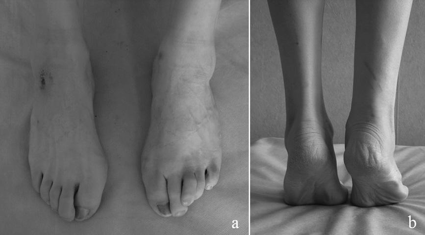 calcaneal avulsion fracture (type 3B) treated conservatively in the context of juvenile-onset diabetes mellitus.