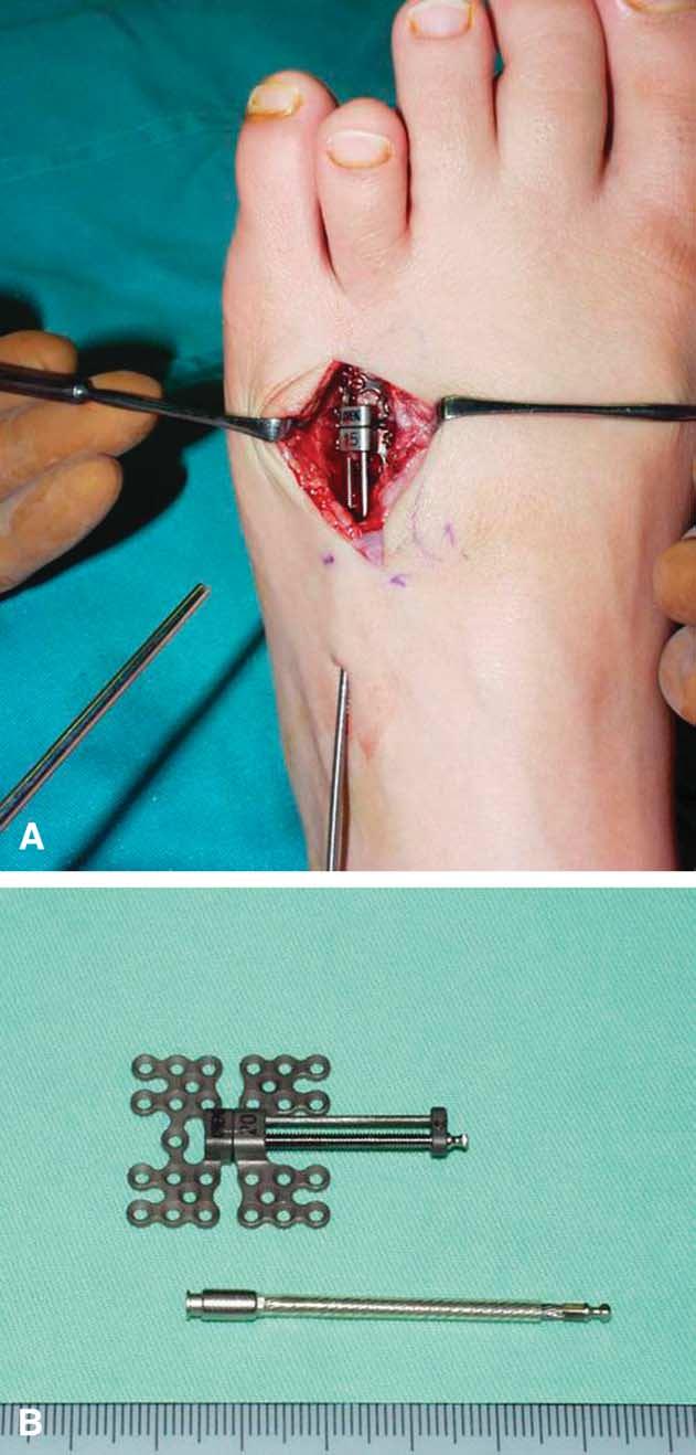 1016 N. Yamada et al. Figure 2 The distraction device installed directly on the metatarsal bone (A) and the distraction device (B). from the seventh postoperative day at a rate of 0.