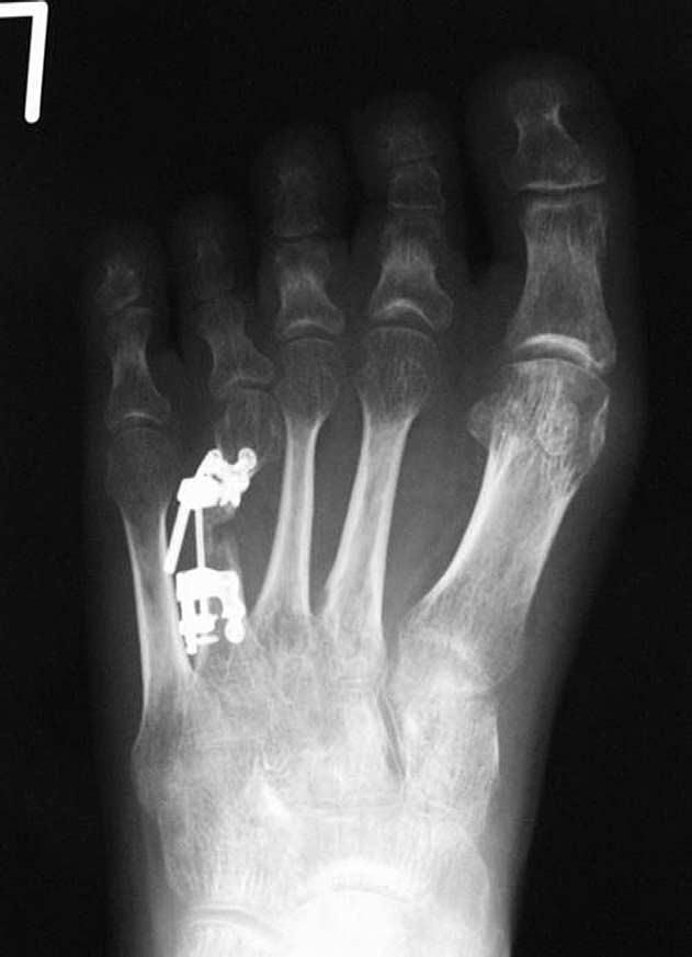 Internal callus distraction 1017 Figure 4 Radiograph of left side on 6 months after operation. Fracture of the callus and breakage of the distraction device were confirmed.