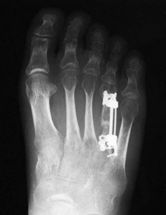 Though ossification of the right 4th toe was radiologically confirmed on 7 months after operation (Fig. 5), the distraction device was not removed until the 17th month after operation.