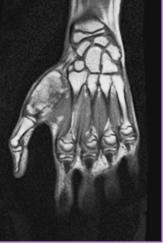 MRI T1 weighted showing a hyperintense lesion with involvement of the whole first metacarpal bone and its marrow, with soft tissue extension to the adductor and flexor pollicis.