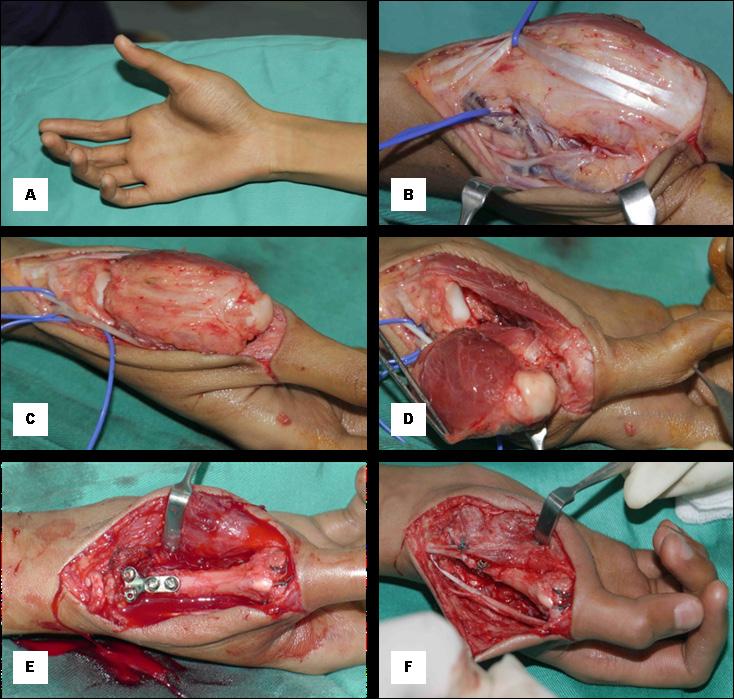 Figure 3. Surgical techniques of resection and primary reconstruction of the first metacarpal bone. (A) Preoperation.