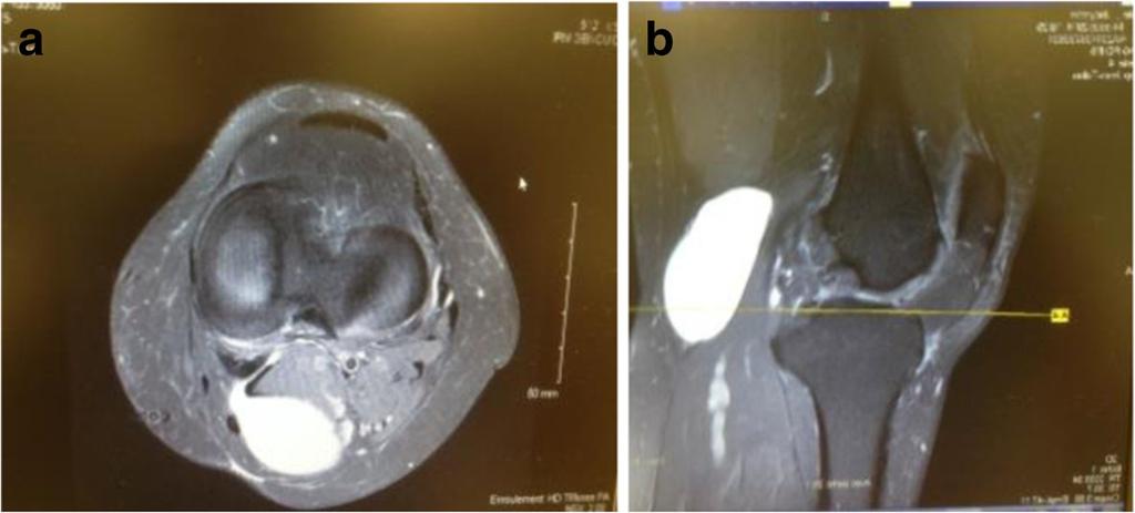 Jiang and Ni Journal of Orthopaedic Surgery and Research (2017) 12:182 Page 2 of 6 When joint effusion in knee osteoarthritis is reduced, popliteal cyst will shrink, even disappear gradually.