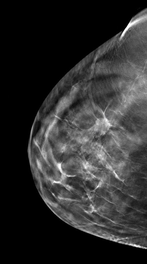 DBT Mammograms MIC uses Digital Breast Tomosynthesis (DBT) for all mammograms.
