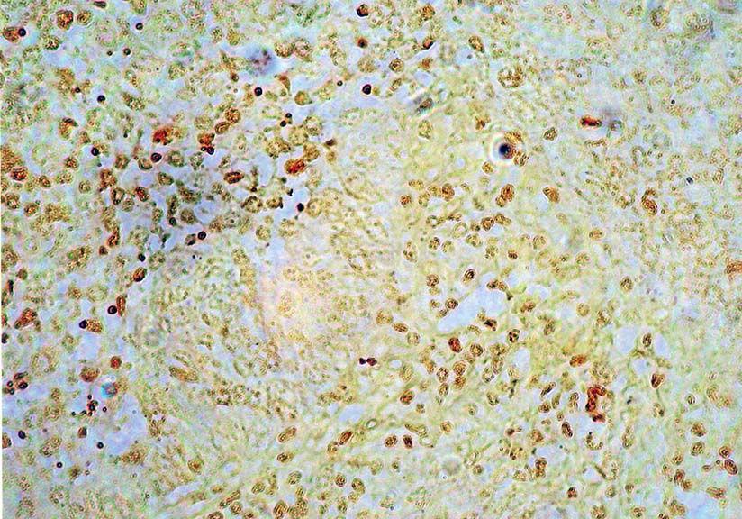 Neuroendocrine carcinoma of the posterior mediastinum; Flexner-Wintersteiner rosette (HE x 400) Slika 2.