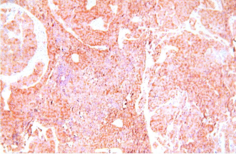 Neuroendocrine carcinoma of the posterior mediastinum (Chromogranin diffuse positive reaction, x 200 )