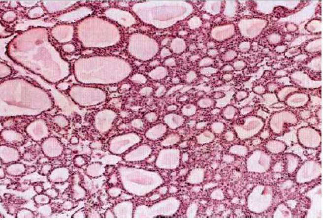 ! 1.2 Benign tumor of epithelial tissue base on their cells of origin and microscopic architecture!
