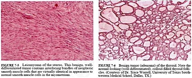 In general, benign tumors are well differentiated cells.