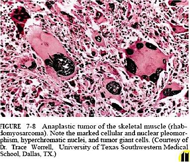 Anaplasia: a condition of cells in which they have poor
