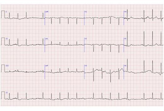 Mobitz Type 2 Regular dropped QRS every 2 nd