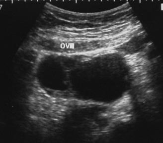 ovarian heterogenous