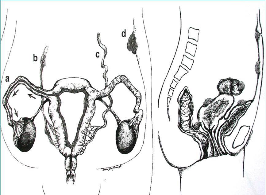 Anatomical distribution of pelvic endometriosis Colorectal endometriosis Péritoneal