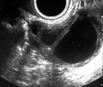 cysts Transvaginal sonography: