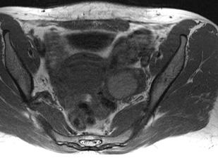 Patient N 3 Sagittal SE T2: hypointense mass in the