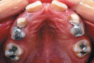 dentition Goal: egin on the lower arch Figure 1- Operative phases of the