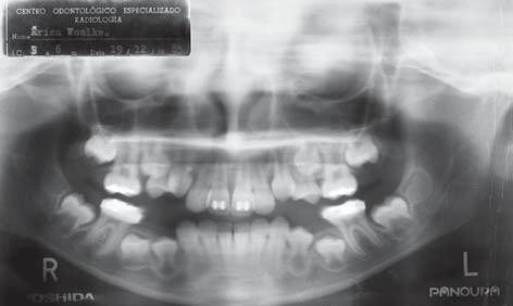 In the interceptive phase, a serial extraction program was performed, which aimed especially at correcting the discrepancies of the dental arch, fostering favorable conditions for a normal