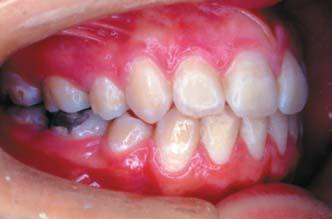 degree of relapse, compatible with that observed in orthodontic posttreatment evaluations, could be noted in this patient.
