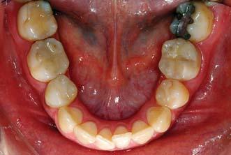 Longitudinal dental arch changes in adults.
